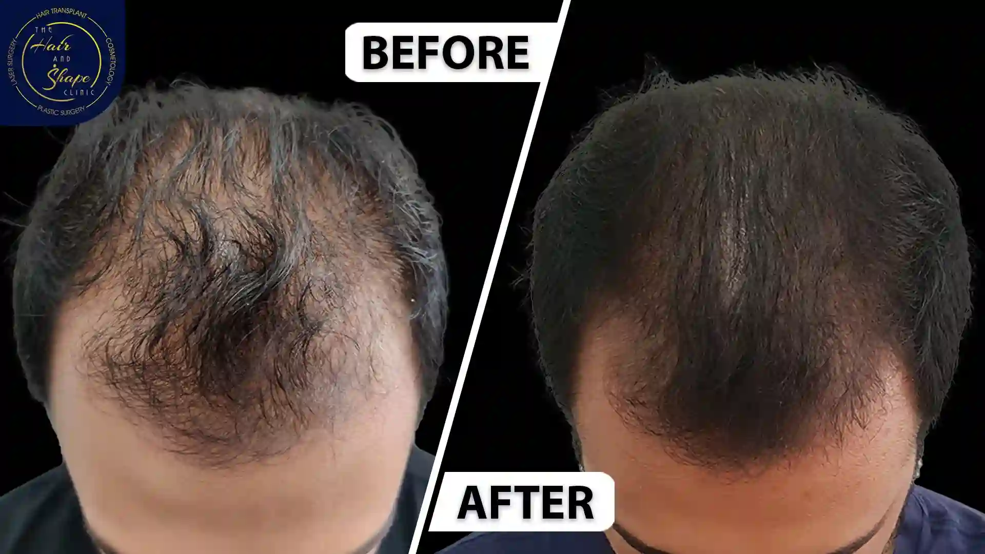 PRP Treatment result3